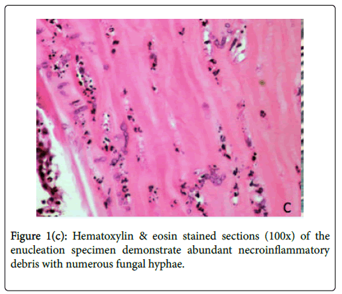 emerging-infectious-diseases-Hematoxylin-eosin