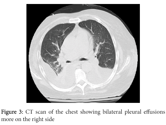 emerging-infectious-diseases-chest-showing-bilateral-pleural-effusions