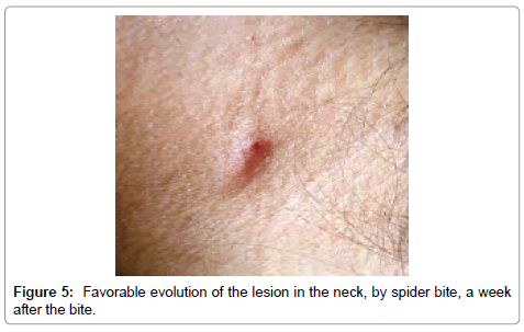 icd 10 code for insect bite left ear