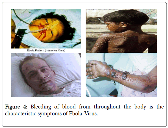 epidemiology-characteristic-symptoms-Ebola-Virus