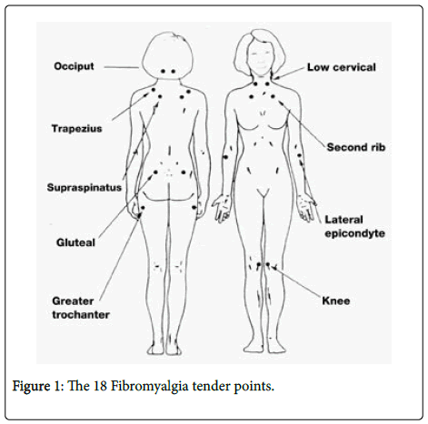 fibromyalgia-Fibromyalgia-tender