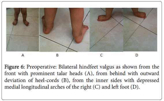 foot-ankle-Bilateral-hindfeet-valgus
