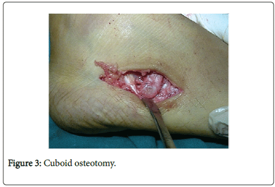 foot-ankle-Cuboid-osteotomy