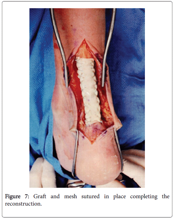 foot-ankle-Graft-mesh-sutured