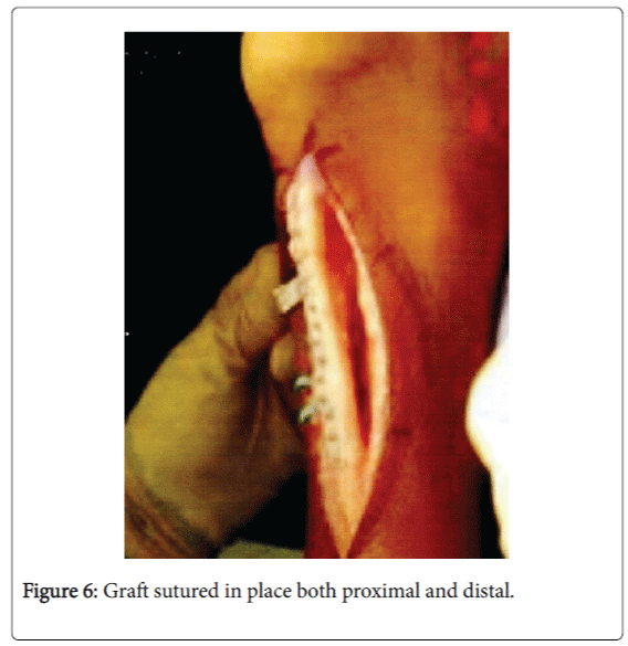 foot-ankle-Graft-sutured-place