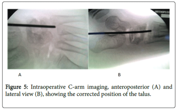 foot-ankle-Intraoperative-C-arm-imaging