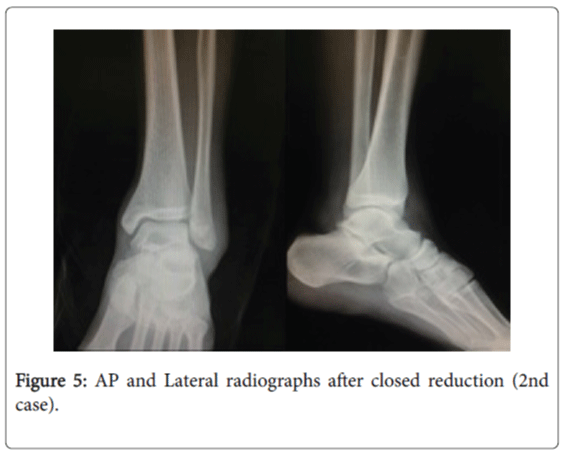 foot-ankle-Lateral-radiographs-closed-reduction