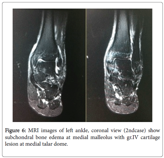 foot-ankle-MRI-left-ankle-subchondral-bone