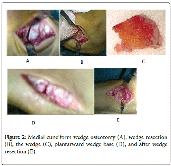 foot-ankle-Medial-cuneiform-wedge-osteotomy