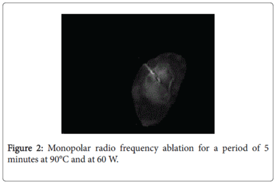 foot-ankle-Monopolar-radio-frequency