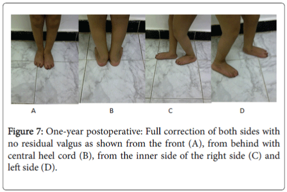 foot-ankle-One-year-postoperative