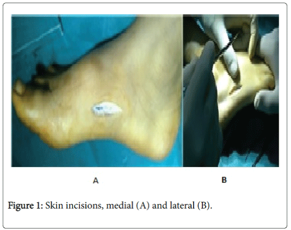 foot-ankle-Skin-incisions-medial