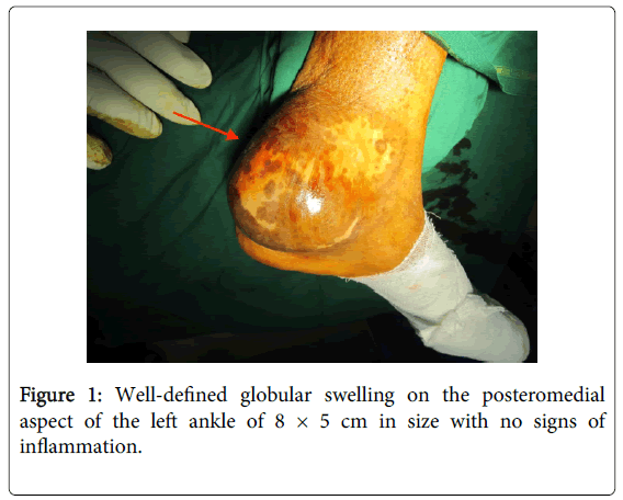foot-ankle-Well-defined-globular