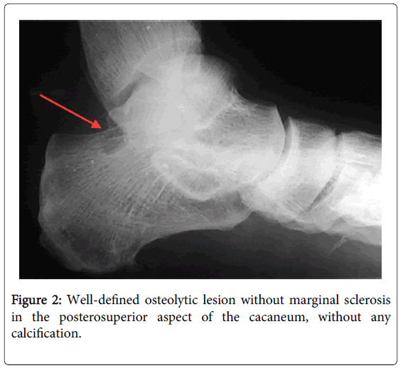 foot-ankle-Well-defined-osteolytic-lesion