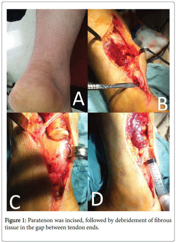 foot-ankle-debridement-fibrous