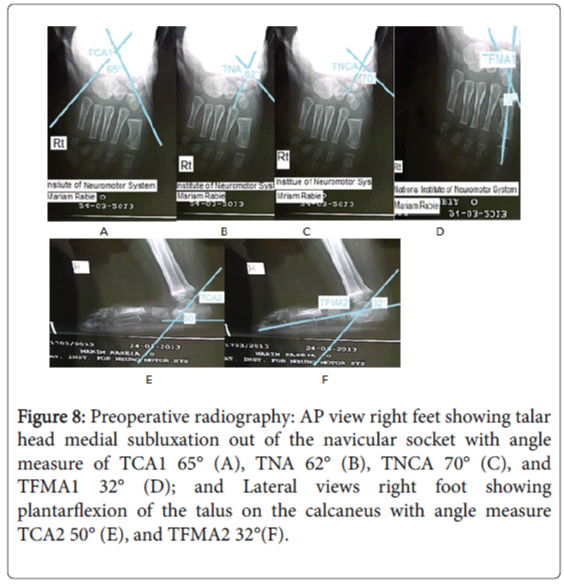 foot-ankle-head-medial-subluxation