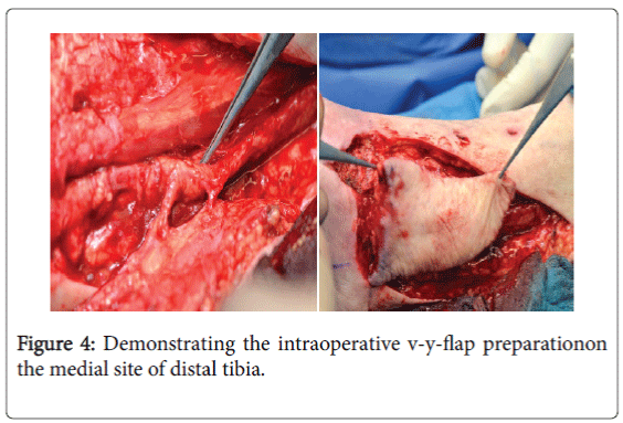 foot-ankle-intraoperative-v-y-flap