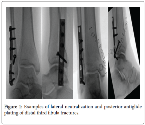 foot-ankle-lateral-neutralization-posterior