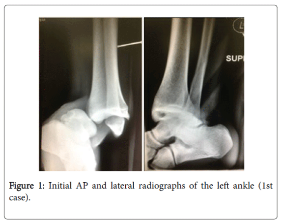 foot-ankle-lateral-radiographs-left-ankle