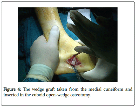 foot-ankle-Cuboid-osteotomy