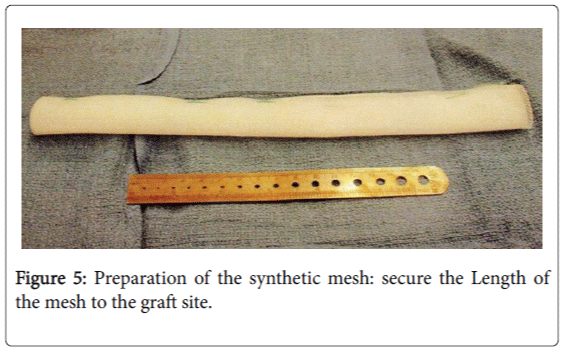 foot-ankle-mesh-graft-site