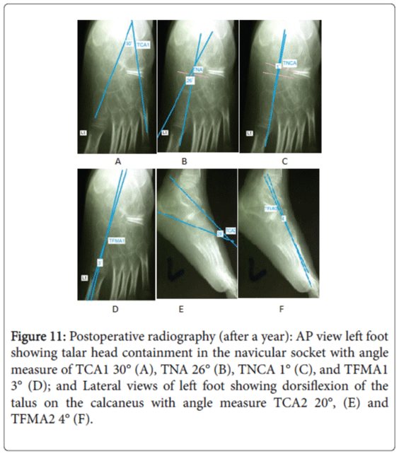 foot-ankle-navicular-socket-angle