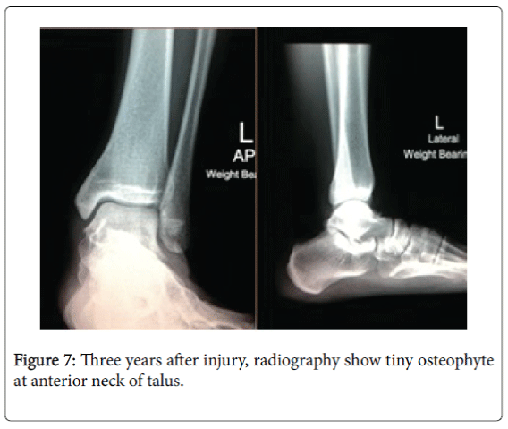 foot-ankle-osteophyte-anterior-neck-talus