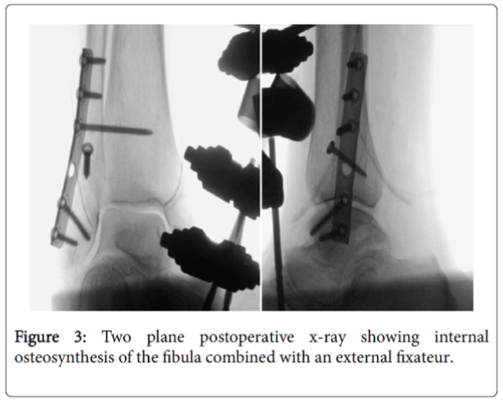 foot-ankle-osteosynthesis-fibula-combined