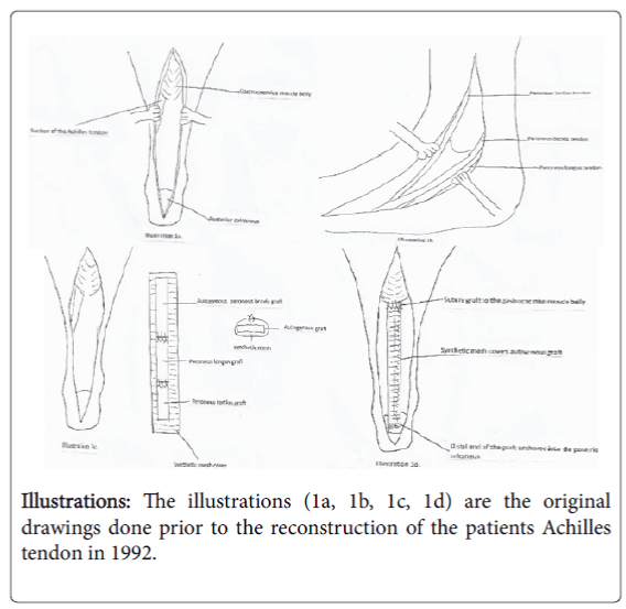 foot-ankle-patients-Achilles