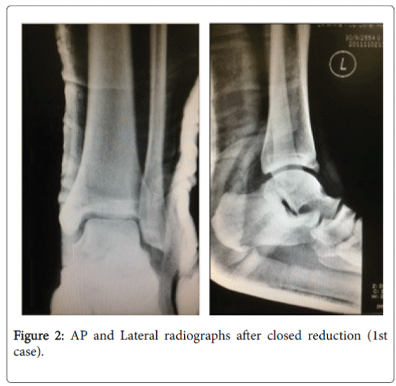 foot-ankle-radiographs-closed-reduction