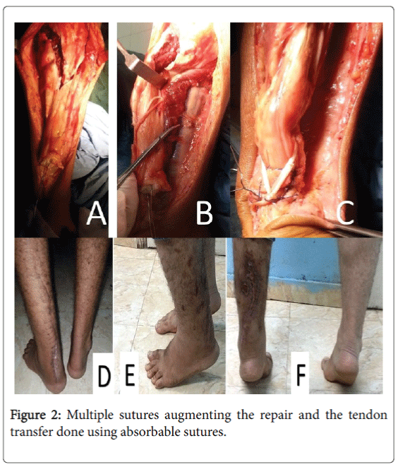 foot-ankle-sutures-augmenting