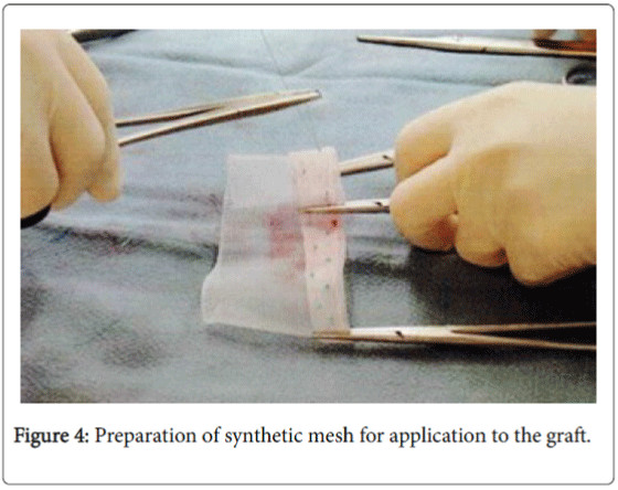 foot-ankle-synthetic-mesh-application