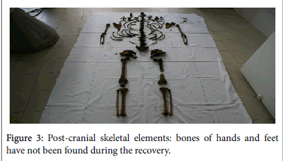 study of skeletal remains solving a homicide case with forensic
