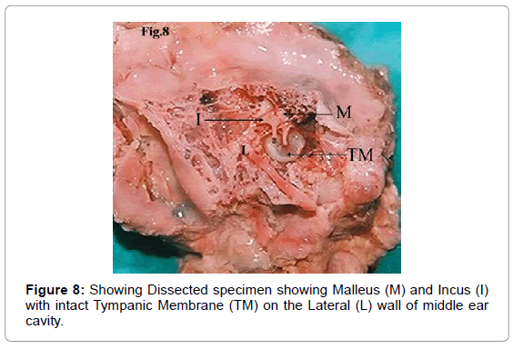 cobblerandrsquo s cut an innovative technique for middle ear