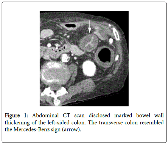 gastrointestinal-digestive-Abdominal-CT-scan-disclosed