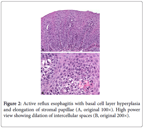 gastrointestinal-digestive-Active-reflux-esophagitis