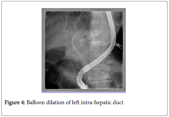 gastrointestinal-digestive-Balloon-dilation