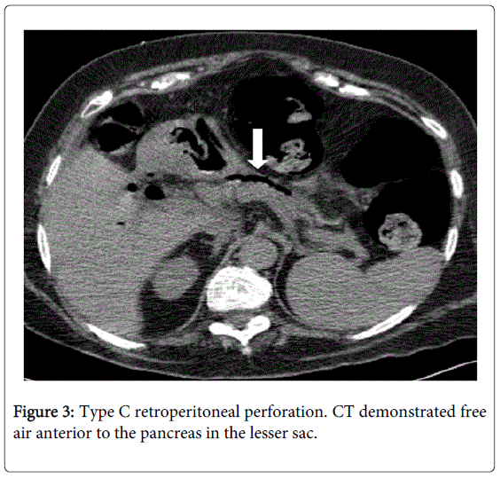 gastrointestinal-digestive-CT-demonstrated-free