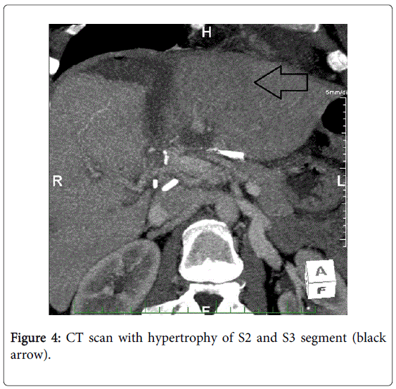 gastrointestinal-digestive-CT-scan-hypertrophy