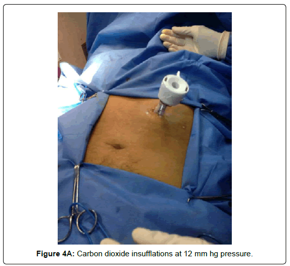 gastrointestinal-digestive-Carbon-dioxide-insufflations