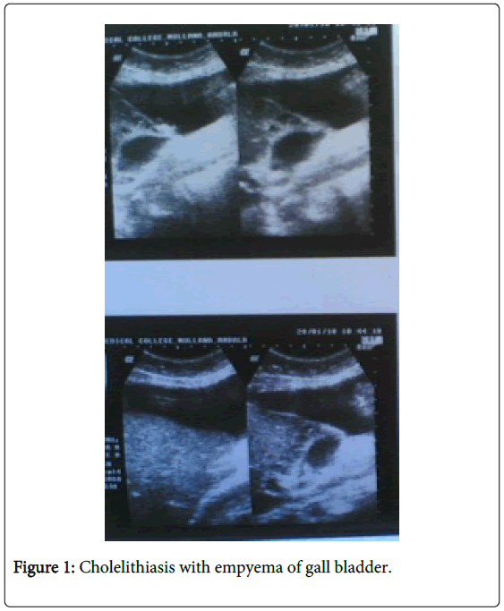 gastrointestinal-digestive-Cholelithiasis-empyema