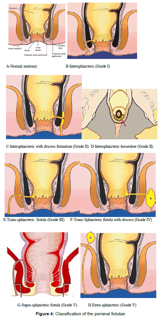 gastrointestinal-digestive-Classification-perianal-fistulae