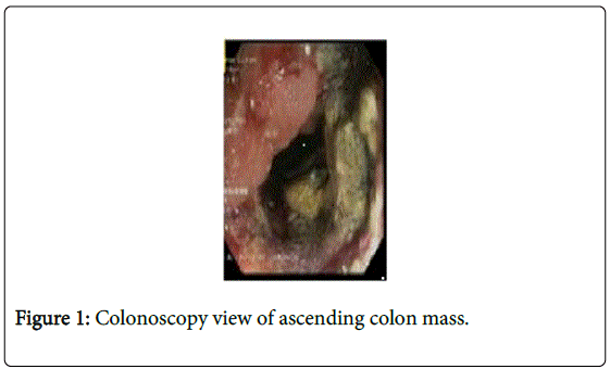 gastrointestinal-digestive-Colonoscopy-ascending