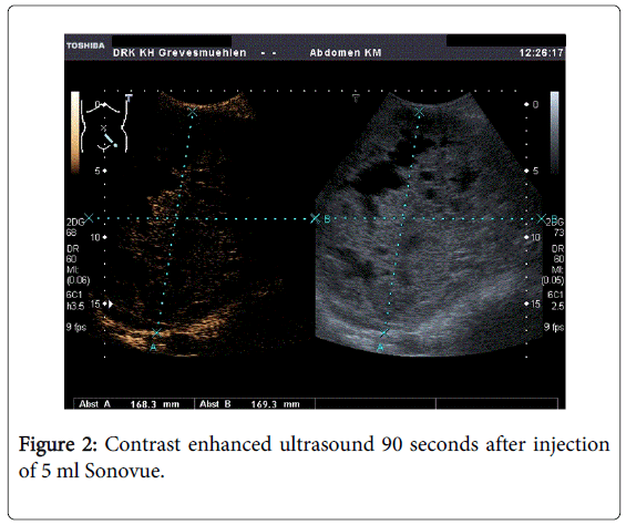 gastrointestinal-digestive-Contrast-enhanced-ultrasound