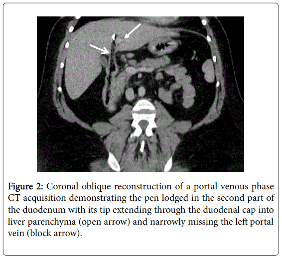 gastrointestinal-digestive-Coronal-oblique-reconstruction