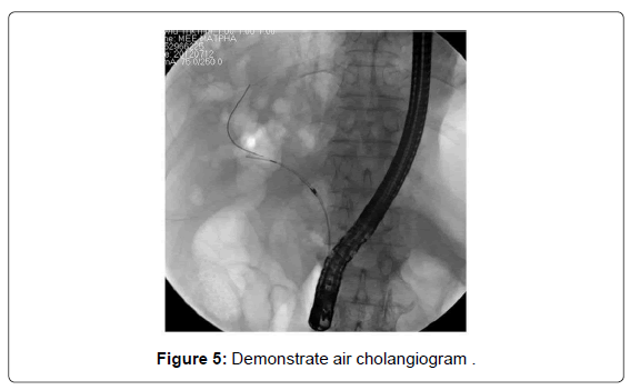 gastrointestinal-digestive-Demonstrate-air-cholangiogram