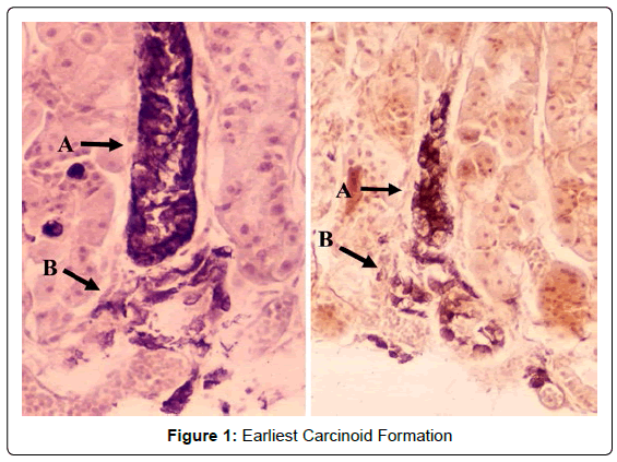 gastrointestinal-digestive-Earliest-Carcinoid