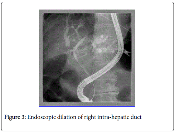 gastrointestinal-digestive-Endoscopic-dilation