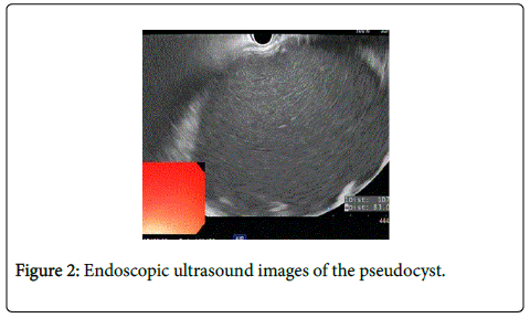 gastrointestinal-digestive-Endoscopic-ultrasound