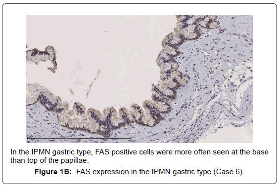 gastrointestinal-digestive-FAS-expression-IPMN